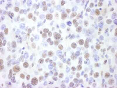 <b>Biological Strategies Validation. </b>Immunohistochemistry: Brg1 Antibody [NBP2-22234] - Sample: FFPE section of mouse renal cell carcinoma. Antibody: Affinity purified rabbit anti- BRG1 used at a dilution of 1:1,000 (1ug/ml). Detection: DAB