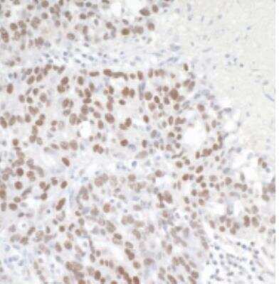 Immunohistochemistry-Paraffin: Brg1 Antibody [NB100-2594] - Section of human ovarian carcinoma. Antibody: Affinity purified rabbit antiBRG1/SMARCA4 used at a dilution of 1:1,000 (0.2ug/ml). Detection: DAB