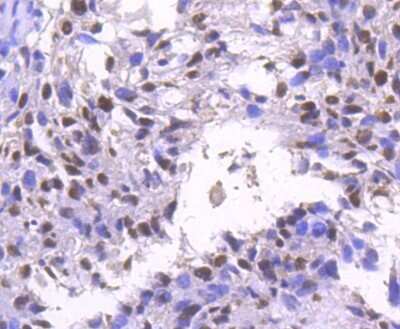 Immunohistochemistry: Brg1 Antibody (SN20-03) - BSA Free [NBP2-74964] - Analysis of paraffin-embedded human breast carcinoma tissue using anti-BRG1 antibody. Counter stained with hematoxylin.