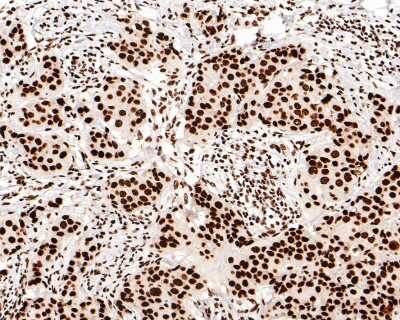 Immunohistochemistry-Paraffin: Brg1 Antibody (SN20-03) [NBP2-67720] - Analysis of paraffin-embedded human breast carcinoma tissue with Rabbit anti-Brg1 antibody washed with ddH2O and PBS, and then probed with the primary antibody at 1/500 dilution for 1 hour at room temperature. The detection was performed using an HRP conjugated compact polymer system. DAB was used as the chromogen. Tissues were counterstained with hematoxylin and mounted with DPX.