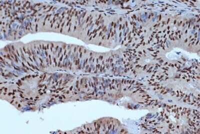 Immunohistochemistry-Paraffin: Bub3 Antibody (10G1S6) [NBP3-16709] - Immunohistochemistry of paraffin-embedded human colon carcinoma using Bub3 Rabbit mAb (NBP3-16709) at dilution of 1:100 (40x lens).Perform microwave antigen retrieval with 10 mM Tris/EDTA buffer pH 9.0 before commencing with IHC staining protocol.