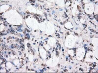 Immunohistochemistry: BubR1 Antibody (OTI6E5) - Azide and BSA Free [NBP2-70314] - Staining of paraffin-embedded Adenocarcinoma of colon tissue using anti-BubR1 mouse monoclonal antibody.