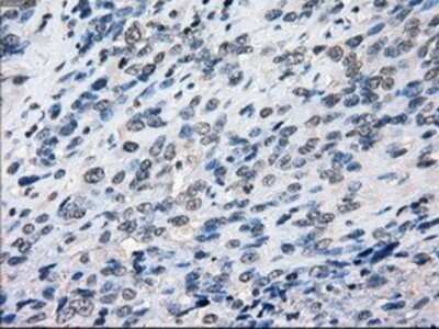 Immunohistochemistry: BubR1 Antibody (OTI6E5) - Azide and BSA Free [NBP2-70314] - Staining of paraffin-embedded Carcinoma of bladder tissue using anti-BubR1 mouse monoclonal antibody.