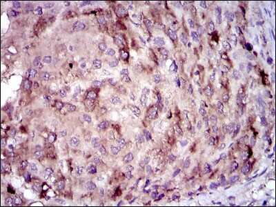 Immunohistochemistry-Paraffin: C-Reactive Protein/CRP Antibody (1G1) [NBP2-22192] - Immunohistochemical analysis of paraffin-embedded liver cancer tissues using C-Reactive Protein mouse mAb with DAB staining.