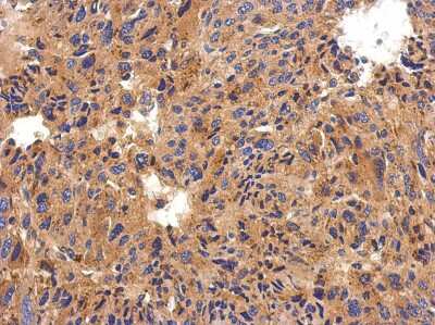 Immunohistochemistry-Paraffin: Serpin G1/C1 Inhibitor Antibody [NBP2-14892] -  Human hepatoma, using C1 inhibitor antibody at 1:500 dilution. Antigen Retrieval: Trilogy™ (EDTA based, pH 8.0) buffer, 15min