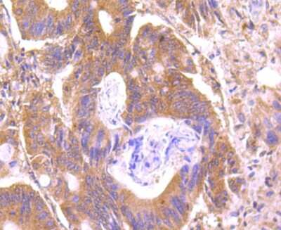 Immunohistochemistry-Paraffin: C14orf93 Antibody (2-F6) [NBP2-75425] - Analysis of paraffin-embedded human colon cancer tissue using anti-C14orf93 antibody. Counter stained with hematoxylin.