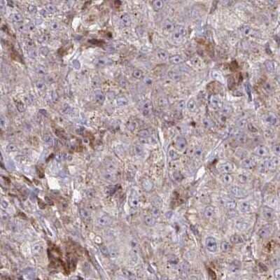 Immunohistochemistry: C16orf54 Antibody [NBP2-32553] - Staining of breast cancer.
