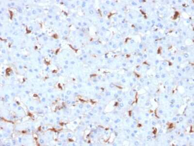 Immunohistochemistry-Paraffin: C1QB Antibody (C1QB/2961) [NBP2-79786] - Formalin-fixed, paraffin-embedded human Hepatocellular Carcinoma stained with C1QB Antibody (C1QB/2961).