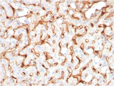 Immunohistochemistry-Paraffin: C1QB Antibody (C1QB/2965) - Azide and BSA Free [NBP2-79921] - Formalin-fixed, paraffin-embedded human Hepatocellular Carcinoma stained with C1QB Mouse Monoclonal Antibody (C1QB/2965).