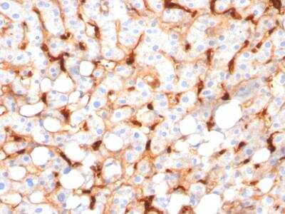 Immunohistochemistry-Paraffin: C1QB Antibody (C1QB/2966) - Azide and BSA Free [NBP2-79922] - Formalin-fixed, paraffin-embedded human Hepatocellular Carcinoma stained with C1QB Mouse Monoclonal Antibody (C1QB/2966).