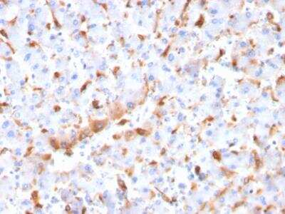 Immunohistochemistry-Paraffin: C1QB Antibody (C1QB/2966) - Azide and BSA Free [NBP2-79922] - Formalin-fixed, paraffin-embedded human Hepatocellular Carcinoma stained with C1QB Mouse Monoclonal Antibody (C1QB/2966).