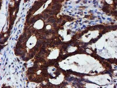 Immunohistochemistry: C1orf50 Antibody (OTI1C6) - Azide and BSA Free [NBP2-72188] - Staining of paraffin-embedded Adenocarcinoma of Human colon tissue using anti-C1orf50 mouse monoclonal antibody.