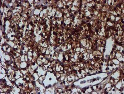 Immunohistochemistry: C1orf50 Antibody (OTI1C6) - Azide and BSA Free [NBP2-72188] - Staining of paraffin-embedded Carcinoma of Human kidney tissue using anti-C1orf50 mouse monoclonal antibody.