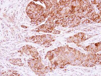 Immunohistochemistry-Paraffin: C21orf33 Antibody [NBP2-15645] - Immunohistochemical analysis of paraffin-embedded Colon ca, using antibody at 1:250 dilution.