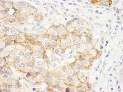 Immunohistochemistry: C2CD5 Antibody [NB100-74596] - Sample: FFPE section of human breast carcinoma. Antibody: Affinity purified rabbit anti-KIAA0528 used at a dilution of 1:1,000 (1ug/ml). Detection: DAB