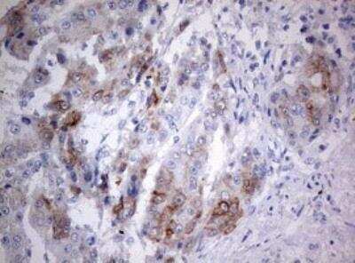 Immunohistochemistry-Paraffin: C3orf15 Antibody (6G1) [NBP2-45449] - Analysis of Carcinoma of Human liver tissue. (Heat-induced epitope retrieval by 10mM citric buffer, pH6.0, 120C for 3min)