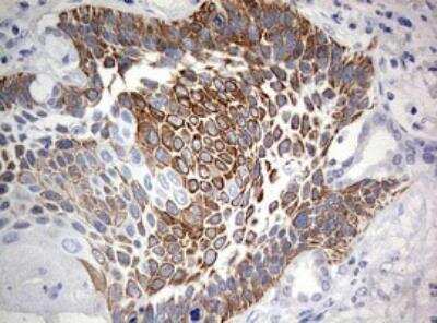 Immunohistochemistry-Paraffin: C3orf15 Antibody (6G1) [NBP2-45449] - Analysis of Carcinoma of Human lung tissue. (Heat-induced epitope retrieval by 10mM citric buffer, pH6.0, 120C for 3min)