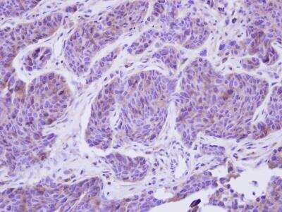 Immunohistochemistry-Paraffin: C8B Antibody [NBP2-15651] - Analysis of paraffin-embedded Breast ca, using antibody at 1:250 dilution.