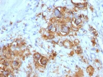 Immunohistochemistry-Paraffin: CA19-9/Sialyl Lewis A Antibody (121SLE) - Azide and BSA Free [NBP2-54349] - Human Gastric Carcinoma stained with CA19-9 MAb (121SLE).