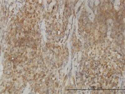 Immunohistochemistry-Paraffin: CAB39L Antibody (3B11-1A4) [H00081617-M01] - Analysis of monoclonal antibody to CAB39L on formalin-fixed paraffin-embedded human lymphoma tissue. Antibody concentration 3 ug/ml.