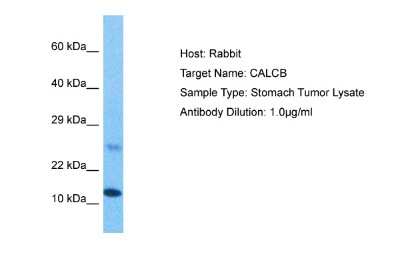 Western Blot: CALCB Antibody [NBP2-83962] - Host: Rabbit. Target Name: CALCB. Sample Tissue: Stomach Tumor lysates. Antibody Dilution: 1ug/ml