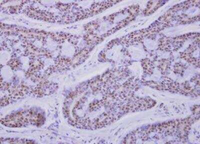 Immunohistochemistry-Paraffin: CAMKID Antibody [NBP1-32831] - Paraffin-embedded breast cancer.  CaMK1D antibody  dilution: 1:500.