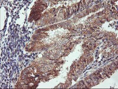 Immunohistochemistry: CAMLG Antibody (OTI1A3) - Azide and BSA Free [NBP2-70331] - Staining of paraffin-embedded Adenocarcinoma of Human endometrium tissue using anti-CAMLG mouse monoclonal antibody.