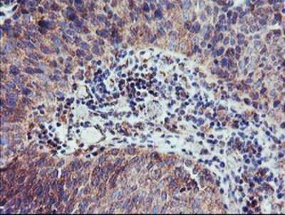 Immunohistochemistry: CAMLG Antibody (OTI1A3) - Azide and BSA Free [NBP2-70331] - Staining of paraffin-embedded Carcinoma of Human bladder tissue using anti-CAMLG mouse monoclonal antibody.