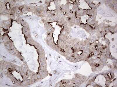 Immunohistochemistry: CAR/NR1I3 Antibody (1C6) [NBP2-46226] - Analysis of Carcinoma of Human liver tissue.(Heat-induced epitope retrieval by 1 mM EDTA in 10mM Tris, pH8.5, 120C for 3min)