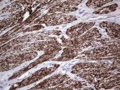 Immunohistochemistry: CAR/NR1I3 Antibody (OTI1C6) - Azide and BSA Free [NBP2-71525] - Analysis of Adenocarcinoma of Human endometrium tissue. (Heat-induced epitope retrieval by 1 mM EDTA in 10mM Tris, pH8.5, 120C for 3min)