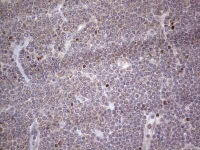 Immunohistochemistry: CAR/NR1I3 Antibody (OTI1C6) - Azide and BSA Free [NBP2-71525] - Analysis of Human lymphoma tissue. (Heat-induced epitope retrieval by 1 mM EDTA in 10mM Tris, pH8.5, 120C for 3min)