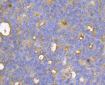 Immunohistochemistry: CASK Antibody [NBP2-76922] - Immunohistochemical analysis of paraffin-embedded human prostate cancer tissue using anti-CASK antibody. Counter stained with hematoxylin.