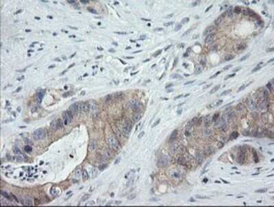 Immunohistochemistry: CATIP Antibody (OTI4B4) - Azide and BSA Free [NBP2-72506] - Analysis of Adenocarcinoma of Human colon tissue.