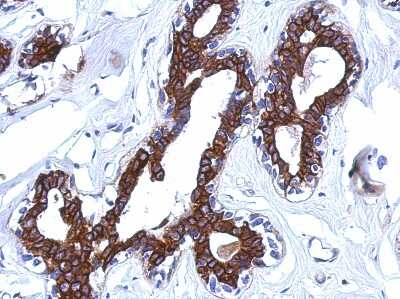 Immunohistochemistry-Paraffin: CBCP6 Antibody [NBP2-15729] - Immunohistochemical analysis of paraffin-embedded BREAST CA, using antibody at 1:500 dilution.