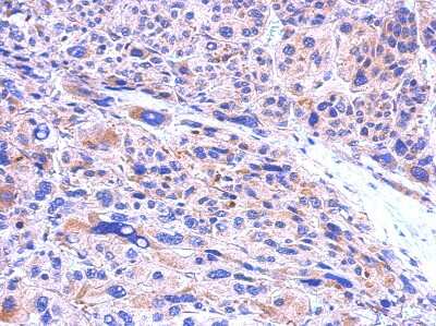 Immunohistochemistry-Paraffin: CBR1 Antibody [NBP1-30942] - Paraffin-embedded Hepatoma; antibody dilution 1:500.