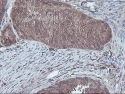 Immunohistochemistry-Paraffin: CBR3 Antibody (1G6) [NBP2-00997] - Staining of paraffin-embedded Adenocarcinoma of Human endometrium tissue using anti-CBR3 mouse monoclonal antibody.