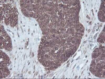 Immunohistochemistry-Paraffin: CBR3 Antibody (1G6) [NBP2-00997] - Staining of paraffin-embedded Adenocarcinoma of Human ovary tissue using anti-CBR3 mouse monoclonal antibody.