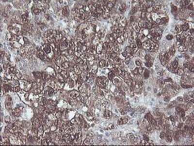 Immunohistochemistry-Paraffin: CBR3 Antibody (1G6) [NBP2-00997] - Staining of paraffin-embedded Carcinoma of Human liver tissue using anti-CBR3 mouse monoclonal antibody.