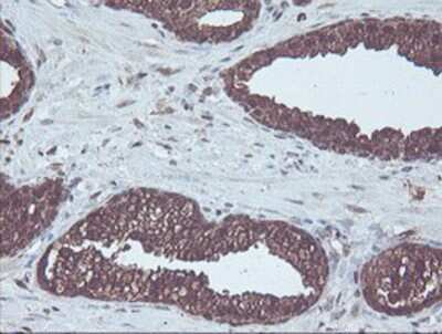 Immunohistochemistry-Paraffin: CBR3 Antibody (1G6) [NBP2-00997] - Staining of paraffin-embedded Carcinoma of Human prostate tissue using anti-CBR3 mouse monoclonal antibody.