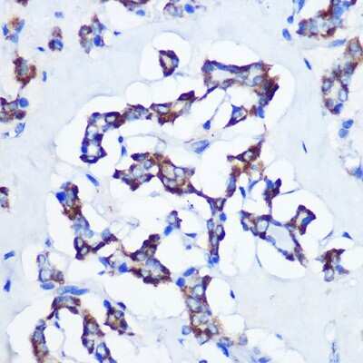 Immunohistochemistry-Paraffin: CBS Antibody (1R2E9) [NBP3-15413] - Immunohistochemistry of paraffin-embedded human thyroid cancer using CBS Rabbit mAb (NBP3-15413) at dilution of 1:100 (40x lens).Perform microwave antigen retrieval with 10 mM PBS buffer pH 7.2 before commencing with IHC staining protocol.