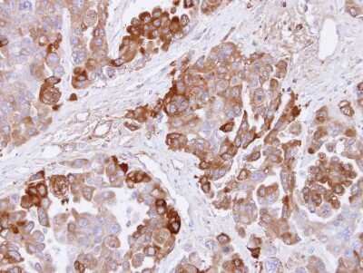 Immunohistochemistry-Paraffin: CBS Antibody [NBP1-33518] -  OVCAR3 xenograft , using CBS antibody at 1:500 dilution. Antigen Retrieval: Trilogy™ (EDTA based, pH 8.0) buffer, 15min.