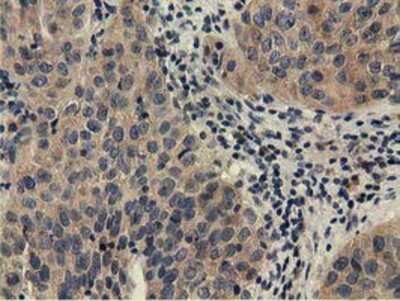 Immunohistochemistry-Paraffin: CBWD1 Antibody (4D4) [NBP2-02931] - Staining of paraffin-embedded Carcinoma of Human bladder tissue using anti-CBWD1 mouse monoclonal antibody.