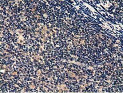 Immunohistochemistry-Paraffin: CBWD1 Antibody (4D4) [NBP2-02931] - Staining of paraffin-embedded Human lymphoma tissue using anti-CBWD1 mouse monoclonal antibody.