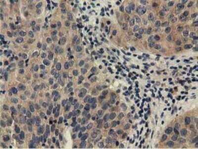 Immunohistochemistry: CBWD1 Antibody (OTI4D4) - Azide and BSA Free [NBP2-72027] - Staining of paraffin-embedded Carcinoma of Human bladder tissue using anti-CBWD1 mouse monoclonal antibody.