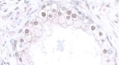 Immunohistochemistry-Paraffin: CBX6 Antibody [NBP1-28731] - Section of human prostate carcinoma. Antibody: Affinity purified rabbit anti-CBX6 (NBP1-28731). Detection: DAB