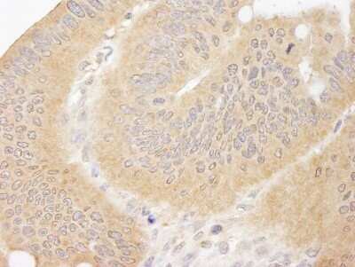 Immunohistochemistry-Paraffin: CC2D1A Antibody [NB500-255] - Human colon carcinoma. Antibody used at a dilution of 1:1000 (1ug/ml).