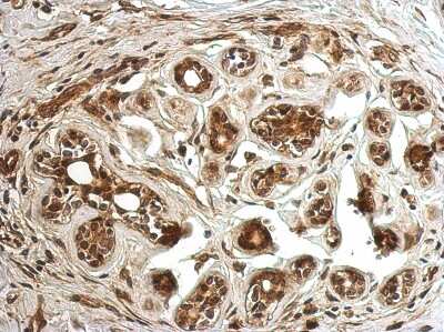 Immunohistochemistry-Paraffin: CC2D2B Antibody [NBP2-15738] - Immunohistochemical analysis of paraffin-embedded Breast ca, using antibody at 1:500 dilution.