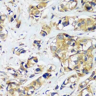 Immunohistochemistry-Paraffin: CCDC124 Antibody [NBP2-92737] - Paraffin-embedded human breast cancer using CCDC124 .