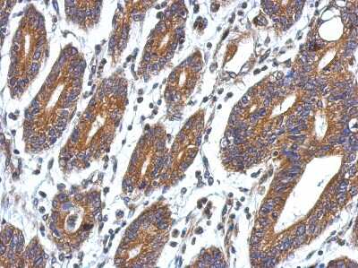 Immunohistochemistry-Paraffin: CCDC127 Antibody [NBP2-15741] - Immunohistochemical analysis of paraffin-embedded Colon ca, using antibody at 1:500 dilution.