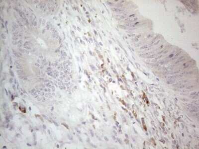 Immunohistochemistry: CCDC36 Antibody (OTI2D11) - Azide and BSA Free [NBP2-72504] - Analysis of Adenocarcinoma of Human colon tissue. (Heat-induced epitope retrieval by 1mM EDTA in 10mM Tris buffer (pH8.5) at 120C for 3 min)